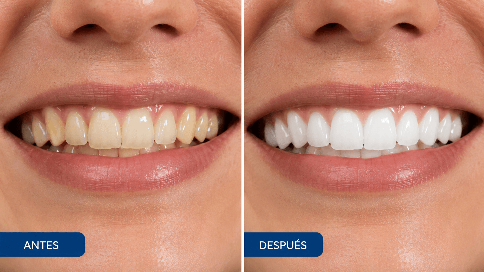 Antes y después — Blanqueamiento