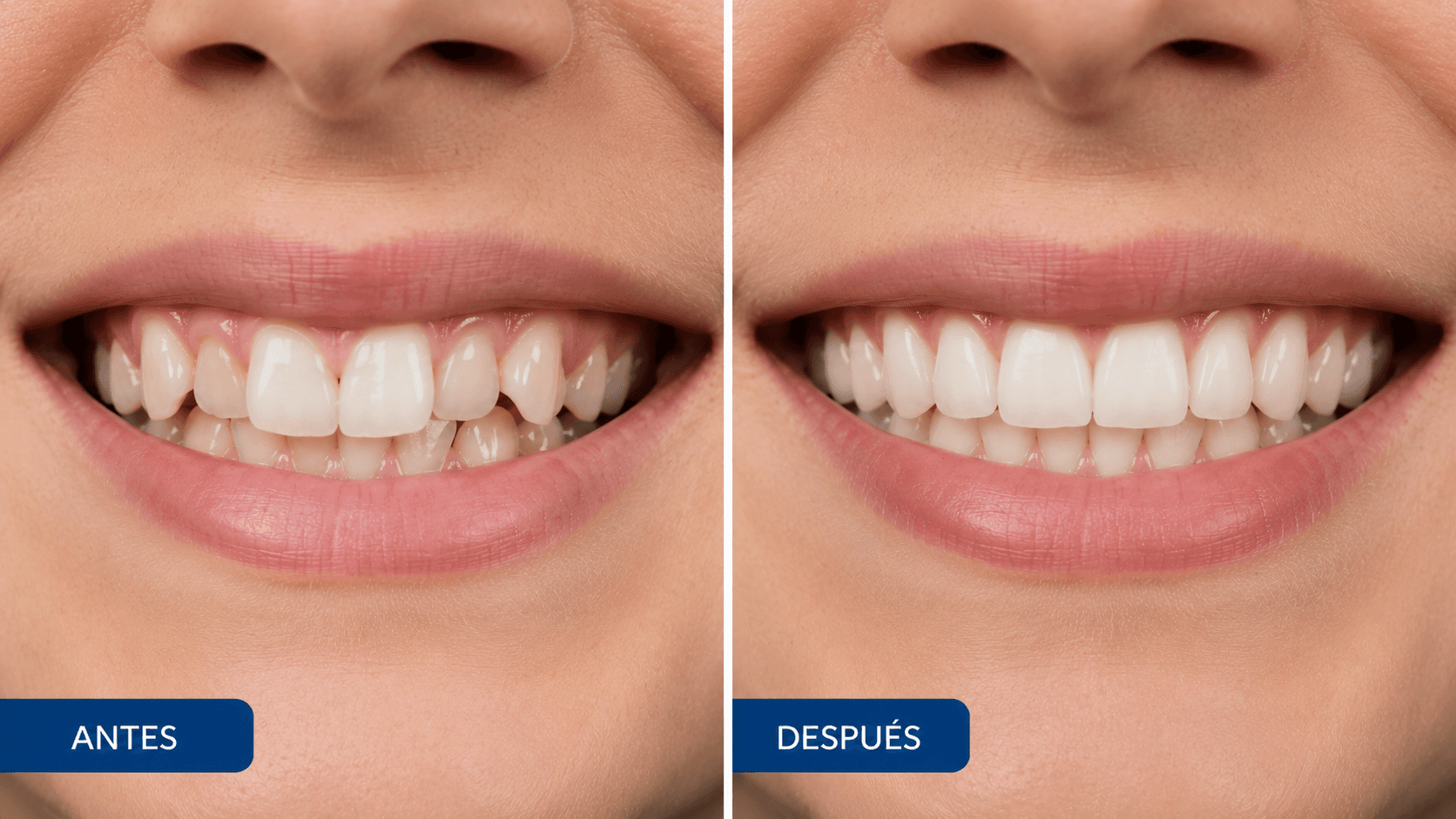 Antes y después — Ortodoncia